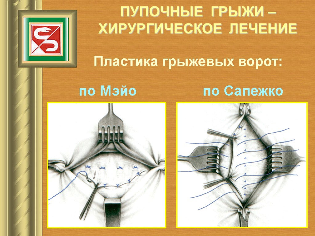 ПУПОЧНЫЕ ГРЫЖИ – ХИРУРГИЧЕСКОЕ ЛЕЧЕНИЕ Пластика грыжевых ворот: по Мэйо по Сапежко